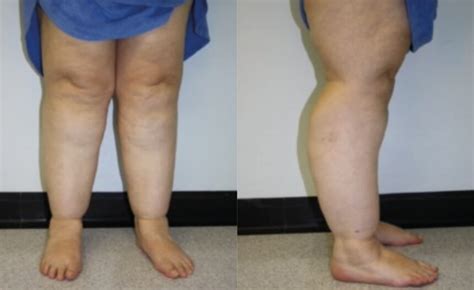 Causes Symptoms And Treatment Of Lipoedema