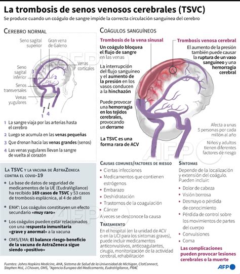 Infograf A Explicativa De La Trombosis De Senos Venosos Cerebrales