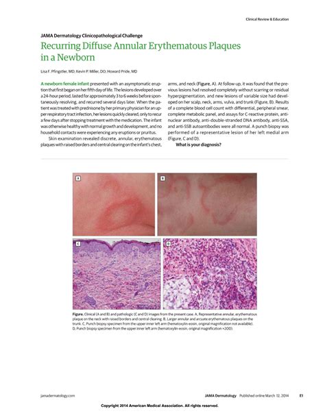 Jama Network Jama Dermatology Recurring Diffuse Annular