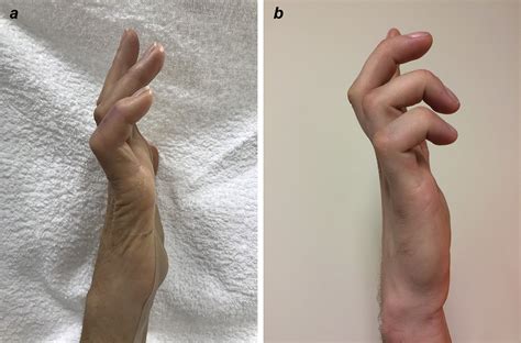 Ulnar Claw A Kinder Gentler Solution Journal Of Hand Therapy