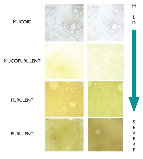 Diagram Of Sinuses And Chart Of Mucus Colors Healthcaretips In 2020