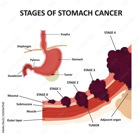 Stages Of Stomach Cancer Classification Of Malignant Tumours Stock Vektorgrafik Adobe Stock