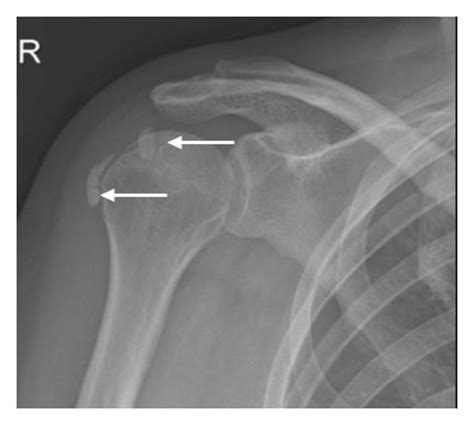 Calcific Tendinitis In A Year Old Female Presenting With Persistent