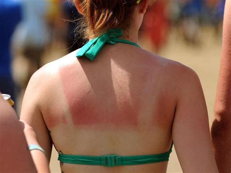 11 Unfortunate Tweets From People Who Have Already Been Sunburnt