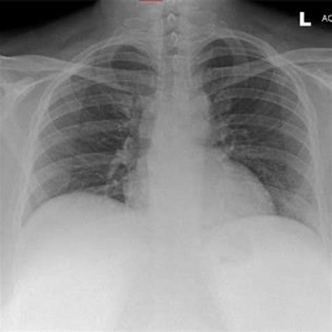 Ap Chest Radiograph Acquired During The Current Presentation To The