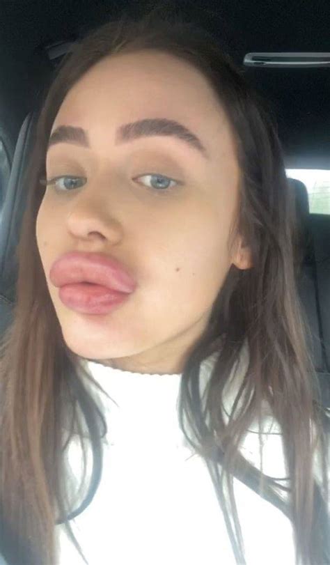 She Just Wanted Bigger Lips Pics Izismile Com