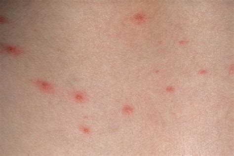 Chicken Pox In Babies And Toddlers Signs Symptoms And Treatments