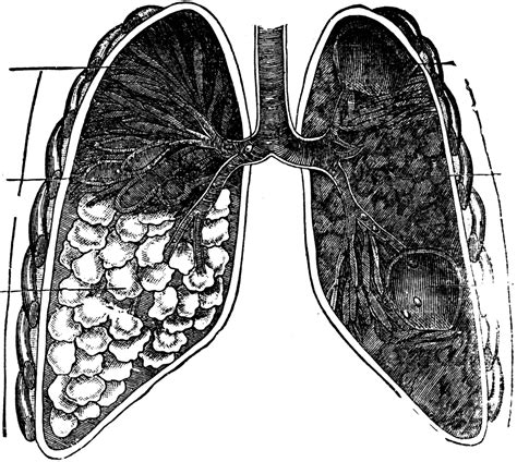 Lung With Tuberculosis ClipArt ETC