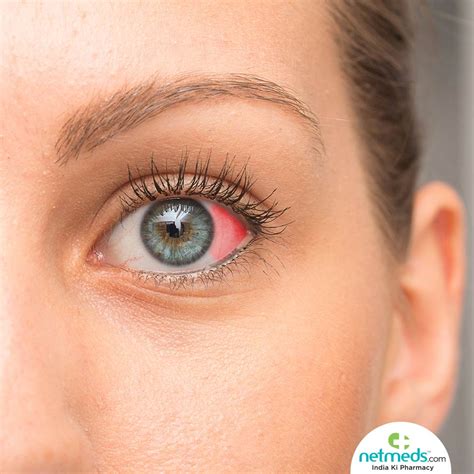 Red Spot On Eye Causes Symptoms And Treatment Netmeds