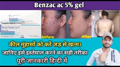 Benzac Ac 5 Gel Use Benefits And Side Effects Full Review In Hindi Youtube