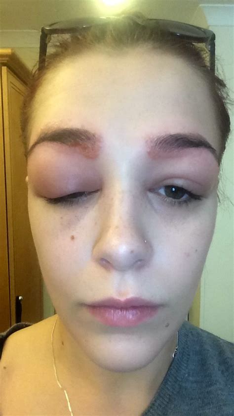 Eyes Dyed Shut Teenager Left Scarred After Disastrous Eyebrow Treatment