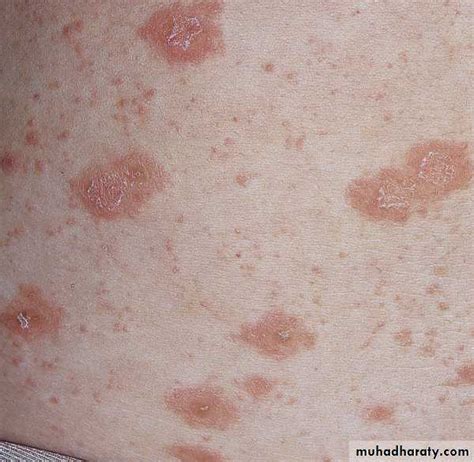 Viral Skin Diseases Pptx دسلام التميمي Muhadharaty