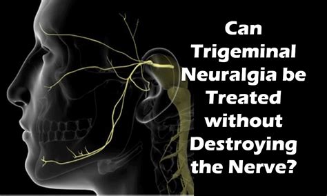 New Treatment For Trigeminal Neuralgia Regenexx