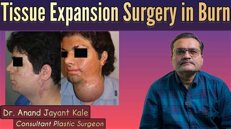 Tissue Expansion Surgery In Burn Dr Anand Jayant Kale YouTube