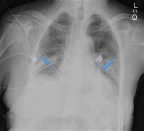 Chest X Ray Revealing Bilateral Chest Tubes See Arrows With Near