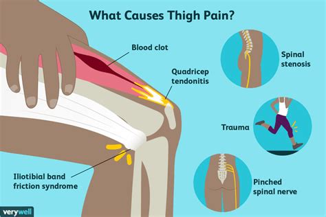 Thigh Pain Causes Treatment And When To See A Doctor