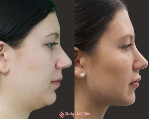 Coolsculpting For Double Chin Benefits Costs Results And Procedure Steps