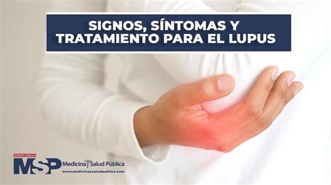 Signos Síntomas Y Tratamiento Para El Lupus Exclusivomsp Youtube