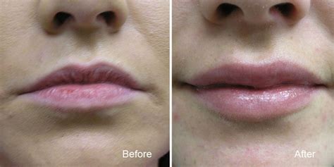 Lip Fillers And Augmentation At Bc Laser And Skin Care Clinic Vancouver