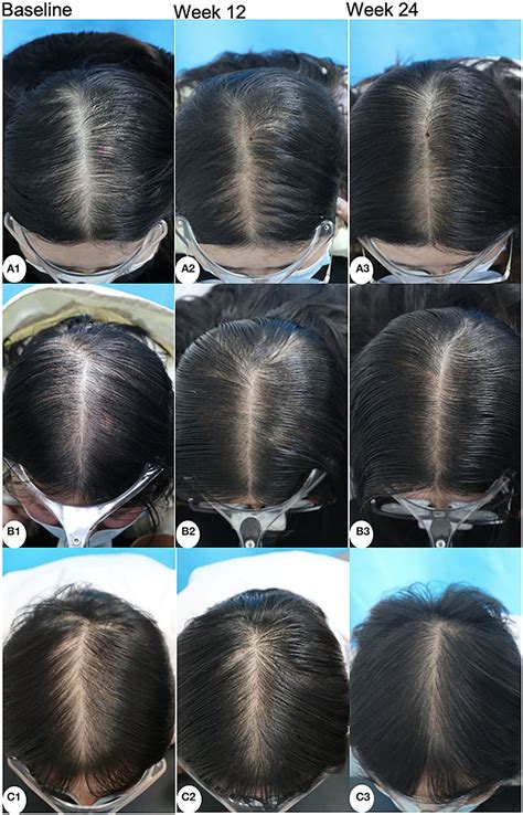 Frontiers Efficacy And Safety Of 5 Minoxidil Alone