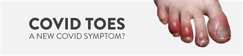 “covid Toes” The New Covid 19 Mystery Symptom Explained Ck Birla Hospital