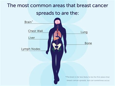 How Fast Does Breast Cancer Spread Lymph Nodes Harness Explains The