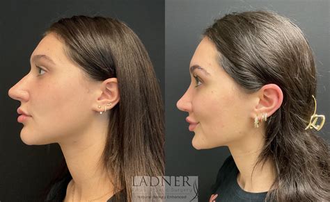 Rhinoplasty Nose Job Before And After Pictures Case Denver Co