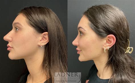 Rhinoplasty Nose Job Before And After Pictures Case Denver CO Ladner Facial Plastic