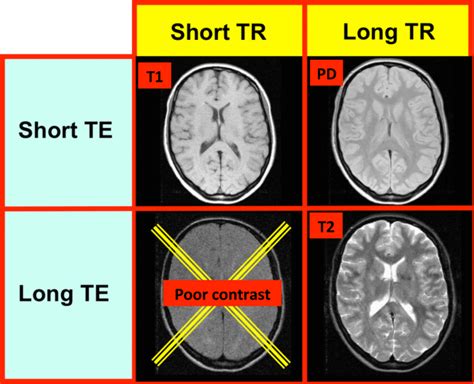 Difference Between T1 And T2 Weighted Mri Images Images Poster