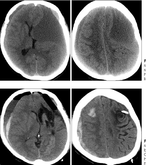 Figure 1 From Contralateral Acute Subdural And Intracerebral