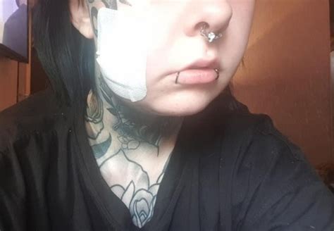 Womans Cheek Piercing Swelled Up And Left Her With A Significant Hole