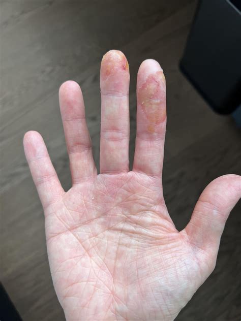 Severe Hand Eczema Help Reczema