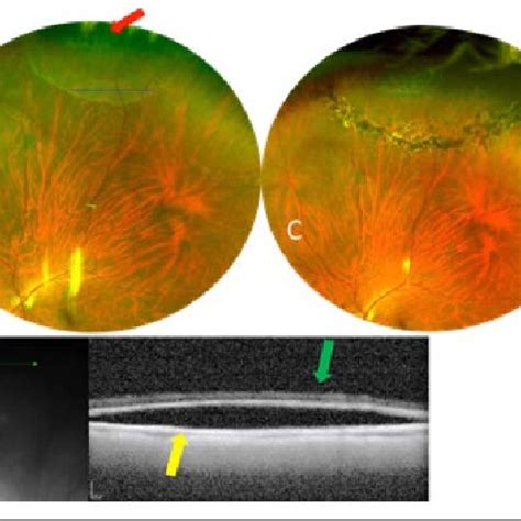 A Superior Region Of Lattice Degeneration With Atrophic Retinal Holes