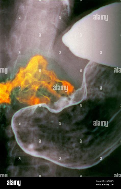 Stomach Cancer Coloured X Ray Of Cancer Orange Of The Antrum Of The