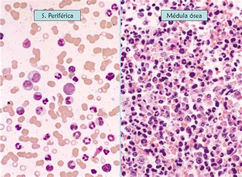 Células Sanguíneas Leucemia Linfoide Y Mieloide Crónica