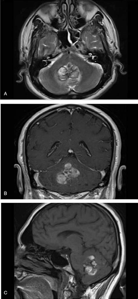 Cerebellum Tumor Presenting Itself With Positional Vertigo A
