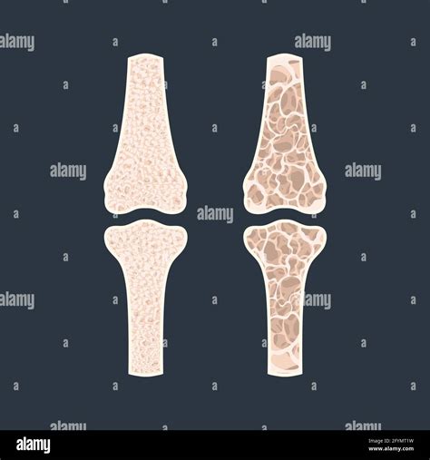 Osteoporosis Conceptual Illustration Stock Photo Alamy