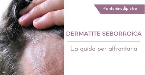 Dermatite Seborroica Cause Sintomi Rimedi Prevenzione La Guida