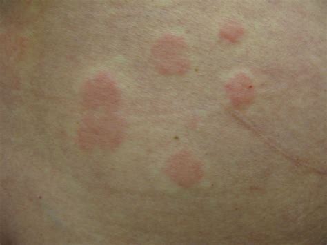 Hives Vs Rash Hives Urticaria Causes Treatment And Symptoms Spots