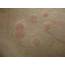 Tips For Diagnosing Treating Urticaria  Dermatology Times And