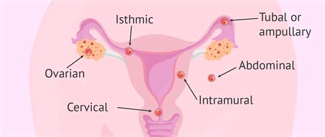 What Is Ectopic Pregnancy Types Symptoms And Diagnosis