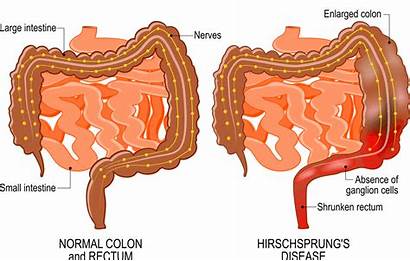 Disease Hirschsprung Pathophysiology Hirschsprungs Affecting Junction Figure