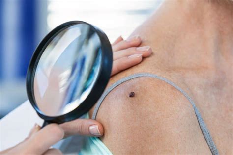 The Importance Of Routine Skin Cancer Screenings Harris Dermatology