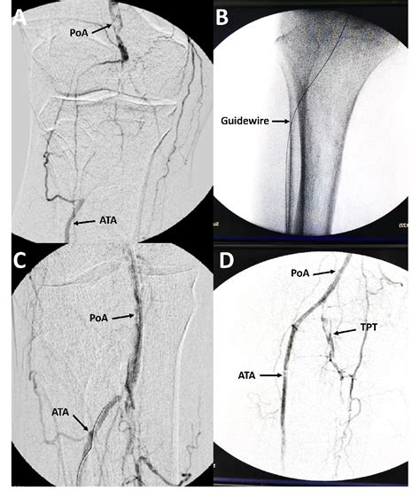 Figure 1 From Endovascular Revascularization Of Chronic Total Arterial