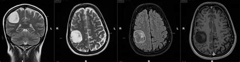 Case Study Awake Brain Tumor Resection Helps Preserve Healthy Tissue
