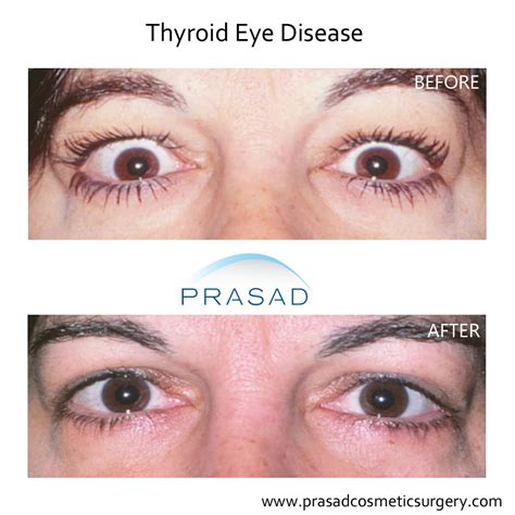 Thyroid Eye Disease Surgery Graves Eye Disease Surgery