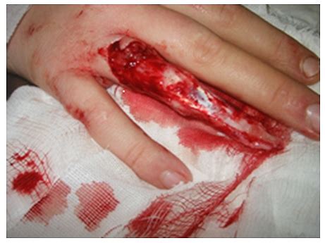 Imaging Severe Hand Trauma - wikiRadiography