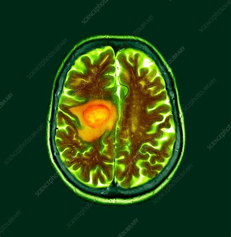 Glioblastoma Brain Cancer Ct Scan Stock Image F0238535 Science