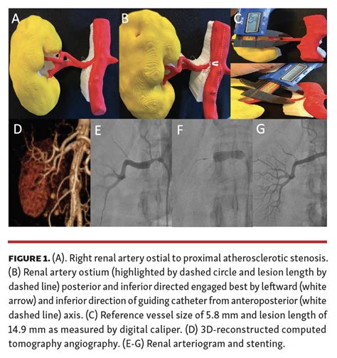3d Printing Of Renal Arteries For Endovascular Interventions