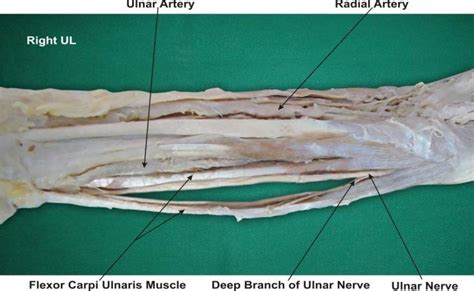 Photographic Representation Of The Ulnar Artery And Nerve Separated By